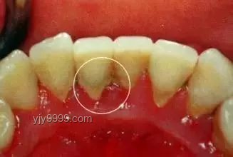 北大“韦神”牙齿问题案例研究：牙周炎的忽视与应对
